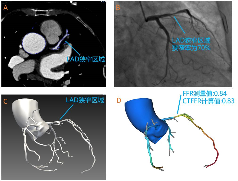 尊龙凯时AG旗舰厅助力睿心医疗—《冠状动脉供血功能（CT-FFR）评估软件》产品完成创新审评及临床试验